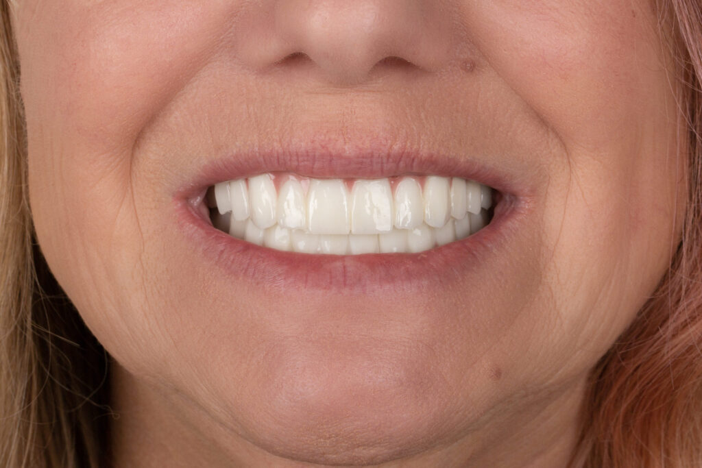 Full Mouth Rehabilitation in dubai