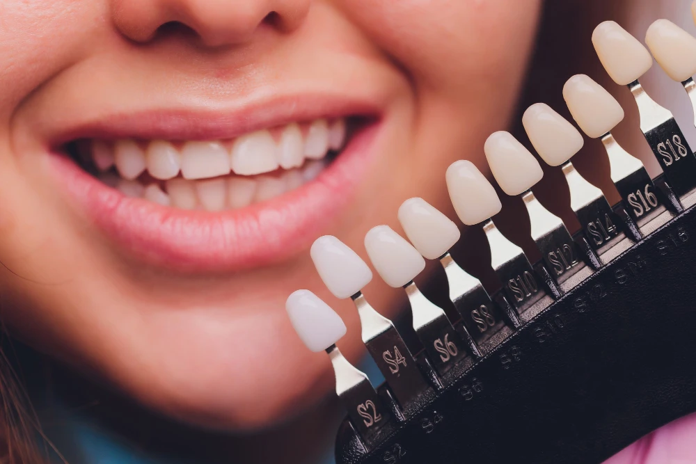 Porcelain Veneers in Dubai