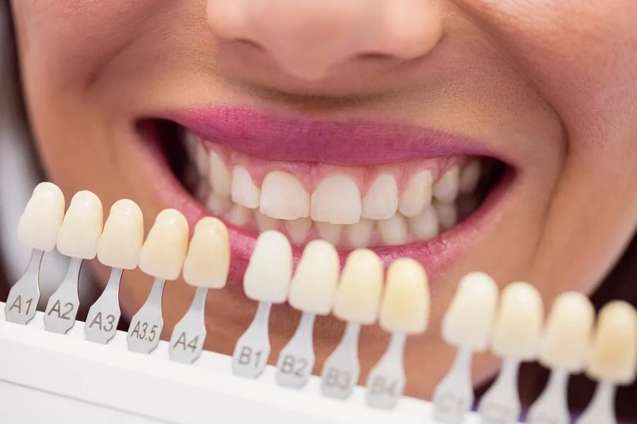 Veneers in Dubai