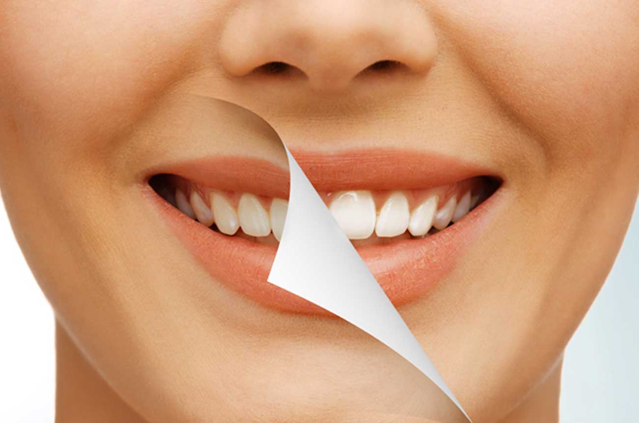 Dental Crowns in Dubai