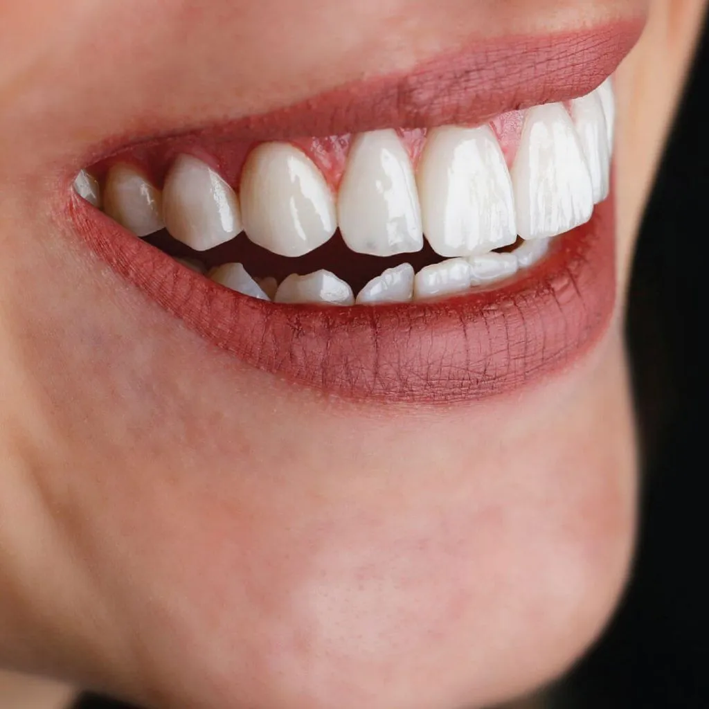 Composite Bonding in Dubai