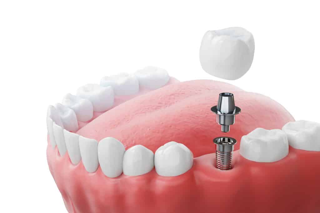 3D Guided Dental Implant