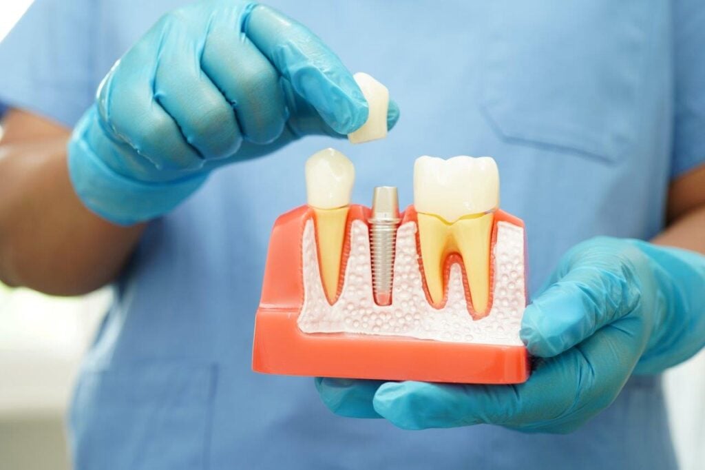 Prosthodontics In Dubai