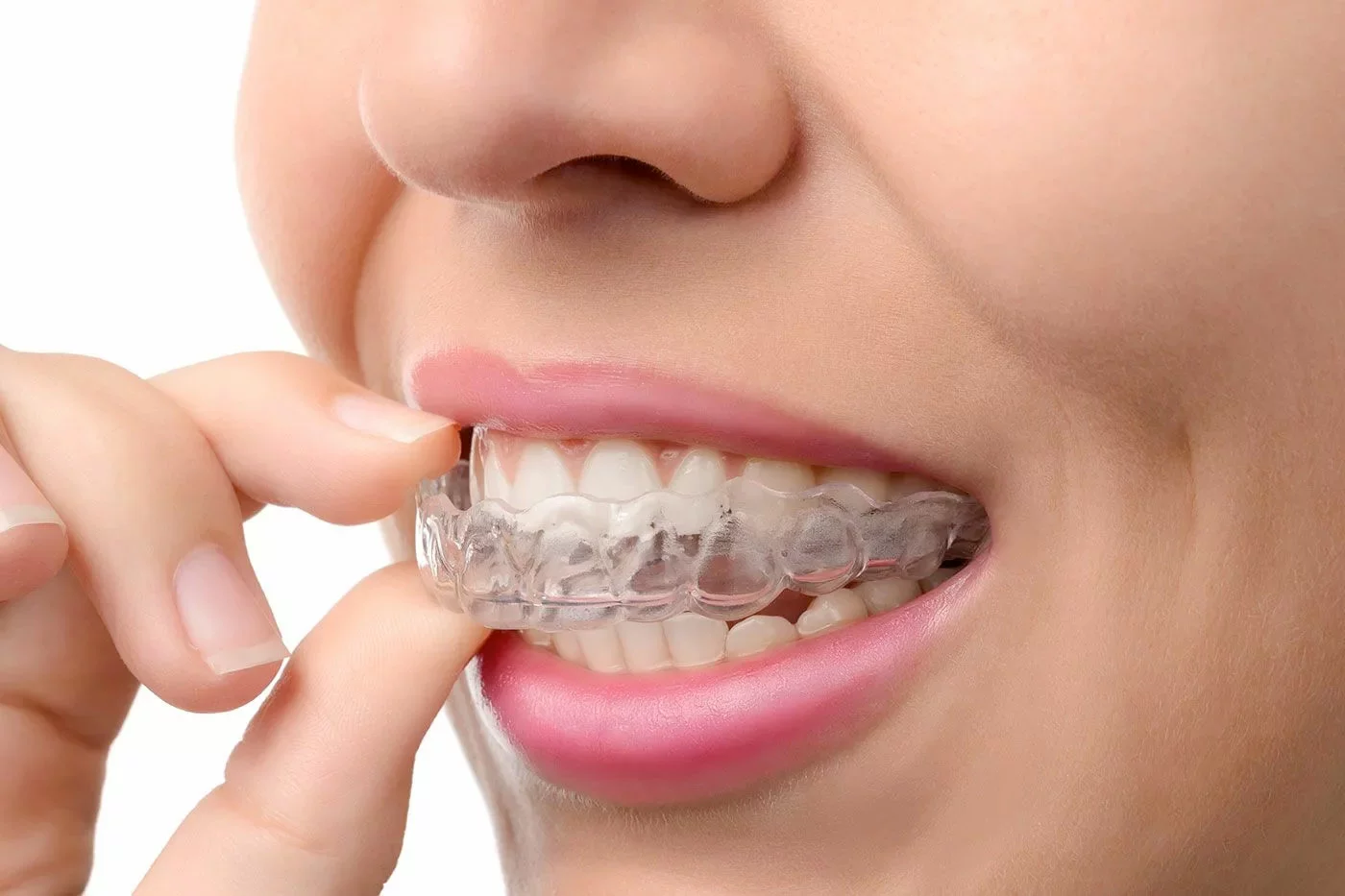 Invisalign in Dubai